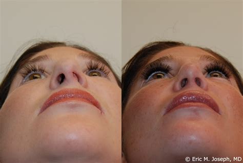 Surgically, you can have two separate incisions under the nose (italian), one incision under the nose (bull horn), one incision at the redwhite upper lip. . How to fix dent on nose after rhinoplasty